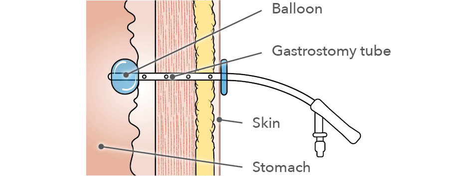 Percutaneous Gastrostomy Tube Peg